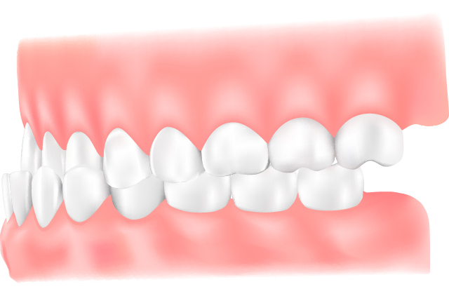 受け口（反対咬合）